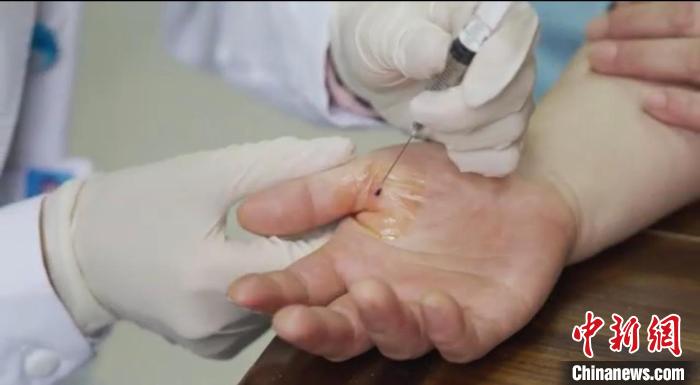 嘉善群眾體驗小針刀。　嘉善統(tǒng)戰(zhàn) 供圖