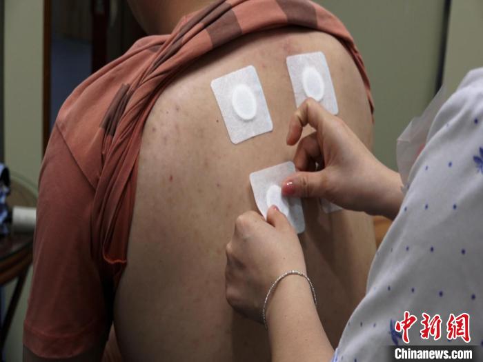 圖為醫(yī)生正在為民眾貼“三伏貼”?！√莆登?攝